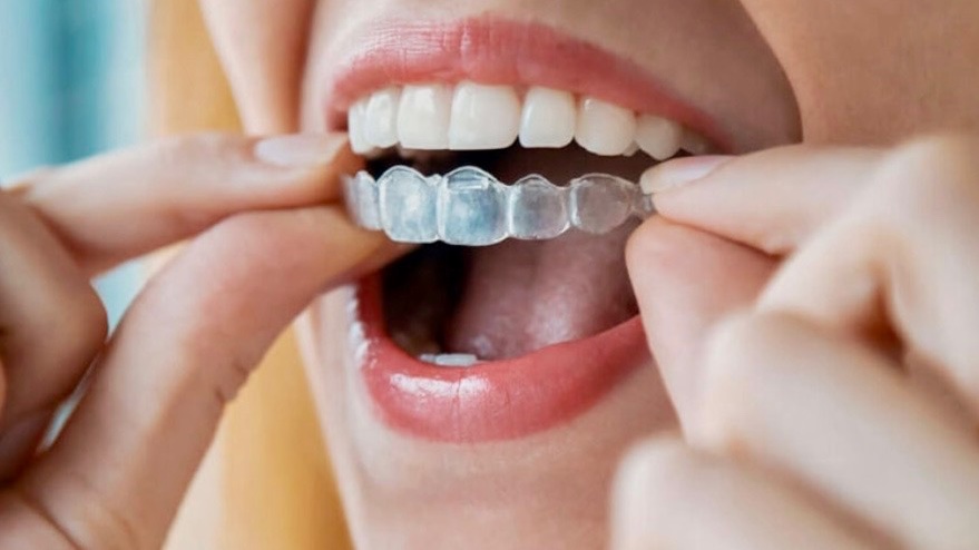 A woman placing a clear aligner tray over her upper teeth