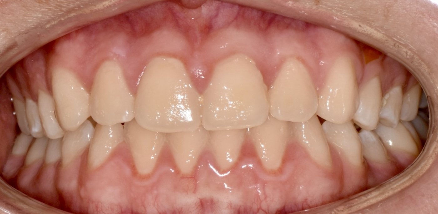 Front view of a child’s teeth, after treatment