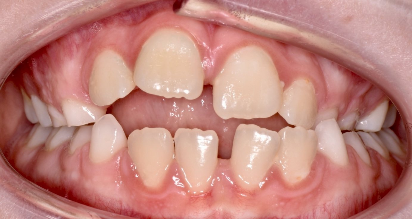 Front view of a child’s teeth, before treatment