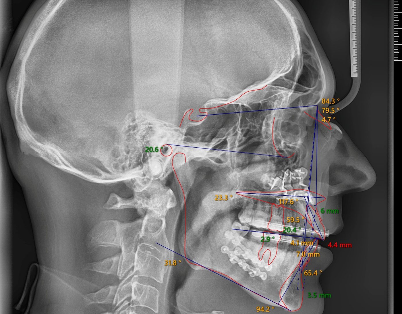 Side-view cephalometric x-ray of an adult patient, after treatment