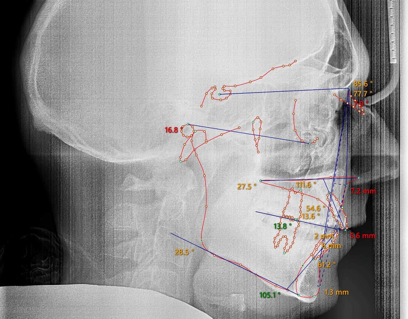 Side-view cephalometric x-ray of an adult patient, before treatment