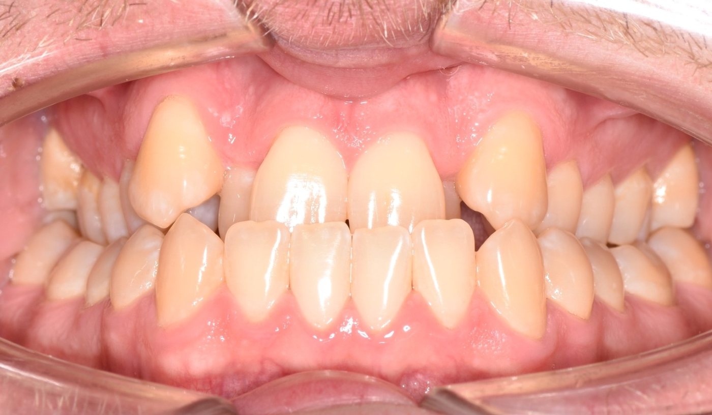 Front view of an adult patient’s teeth, before