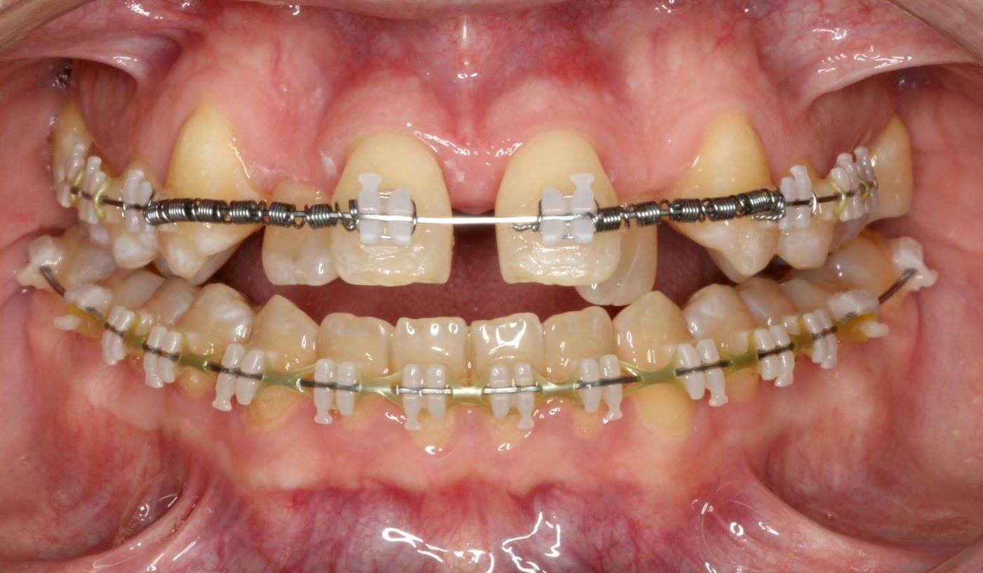 Front view of an adult patient’s teeth, in progress