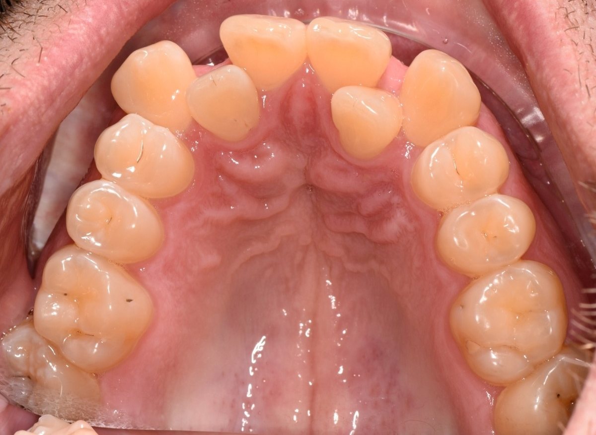 View of the upper jaw and palate from below, before