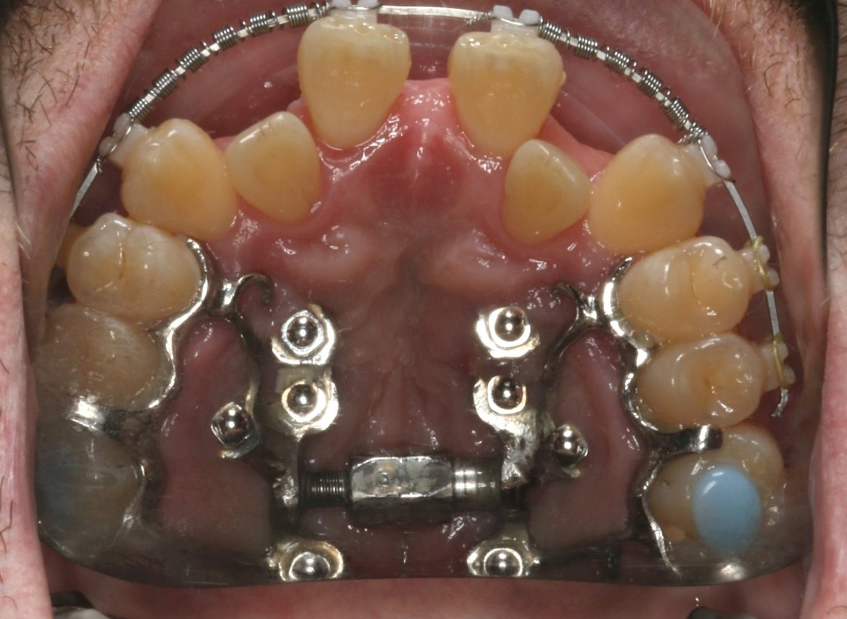 View of the upper jaw and palate from below, in progress