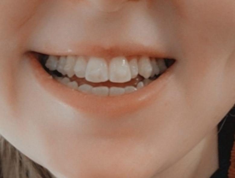 A smile after finished SmileDirectClub treatment, before the patient was retreated at Miller Orthodontics