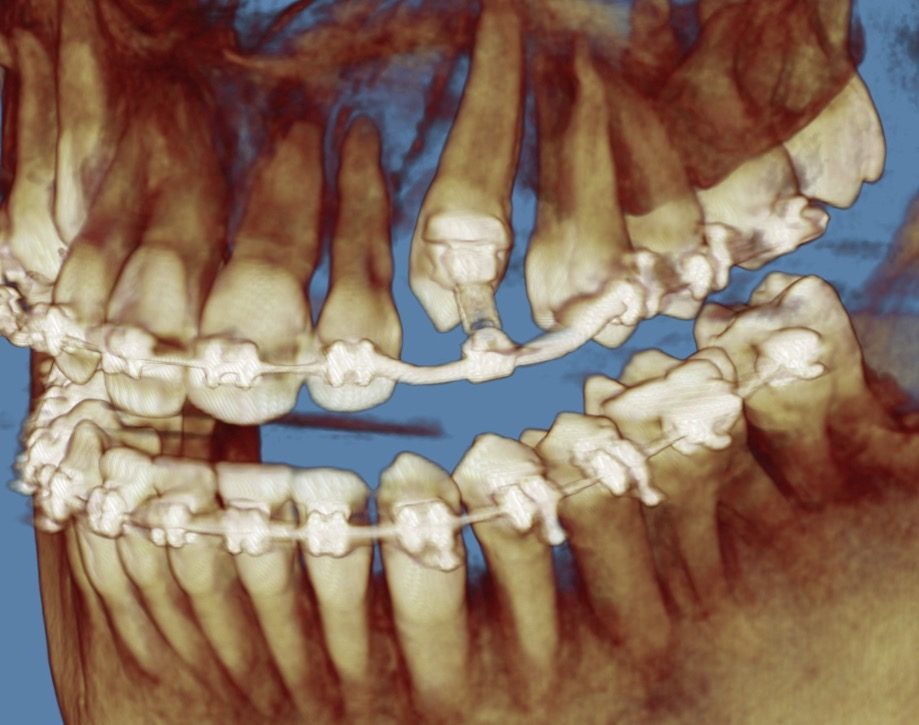 A CBCT 3D scan showing the roots and jaws of a patient in braces