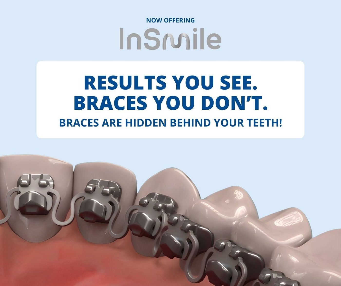 InSmile hidden braces: results you see, braces you don’t. Braces are hidden behind your teeth.