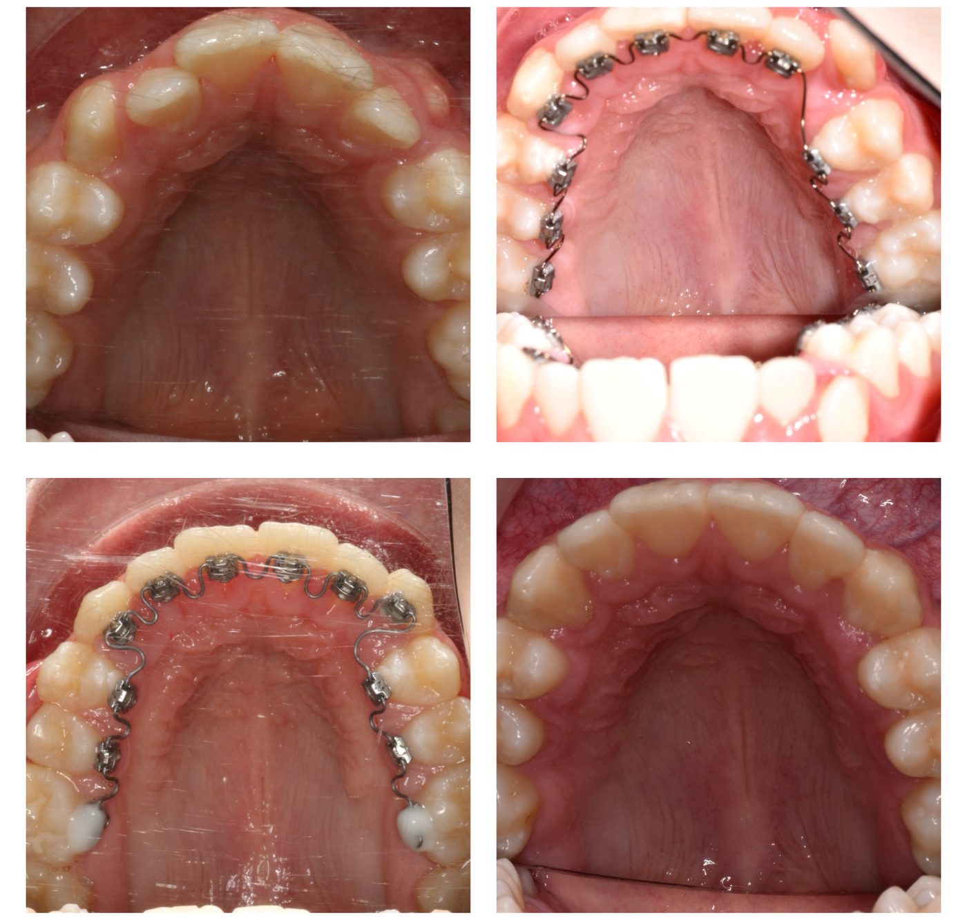Four views of a patient’s upper teeth from the palate side: before, during and after InSmile lingual braces