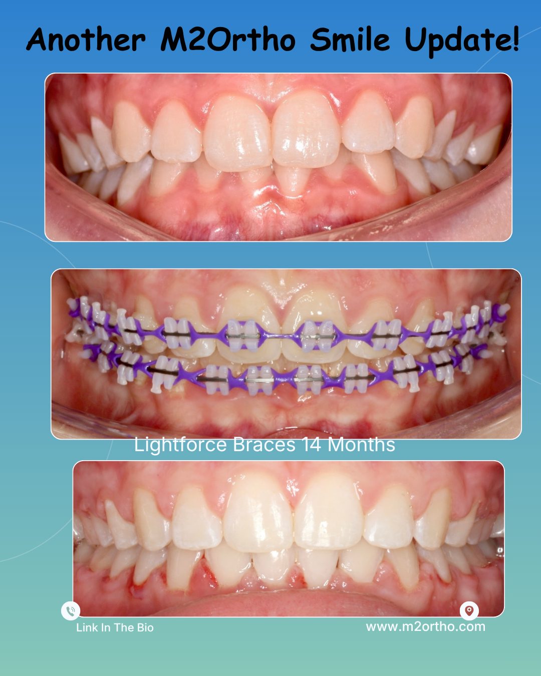 Smile update: a patient’s teeth before, during and after 14 months in Lightforce braces