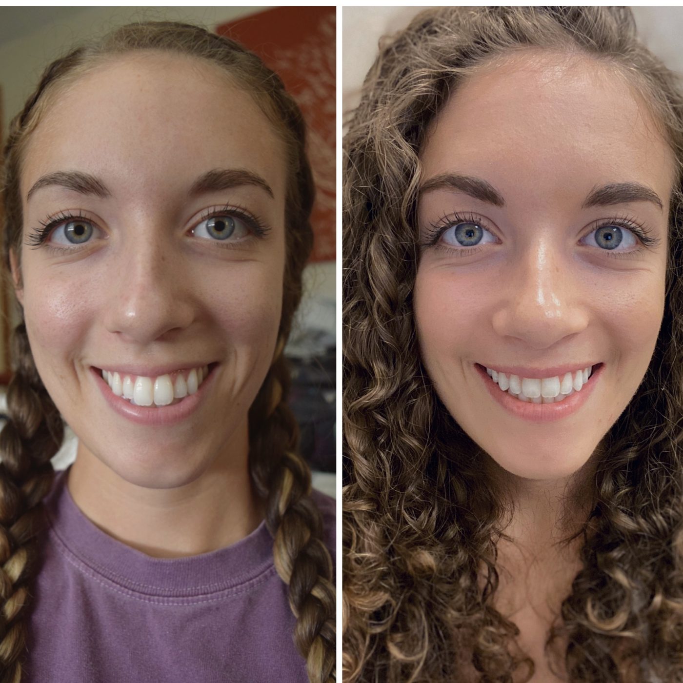 A patient’s smile before and after orthodontic treatment