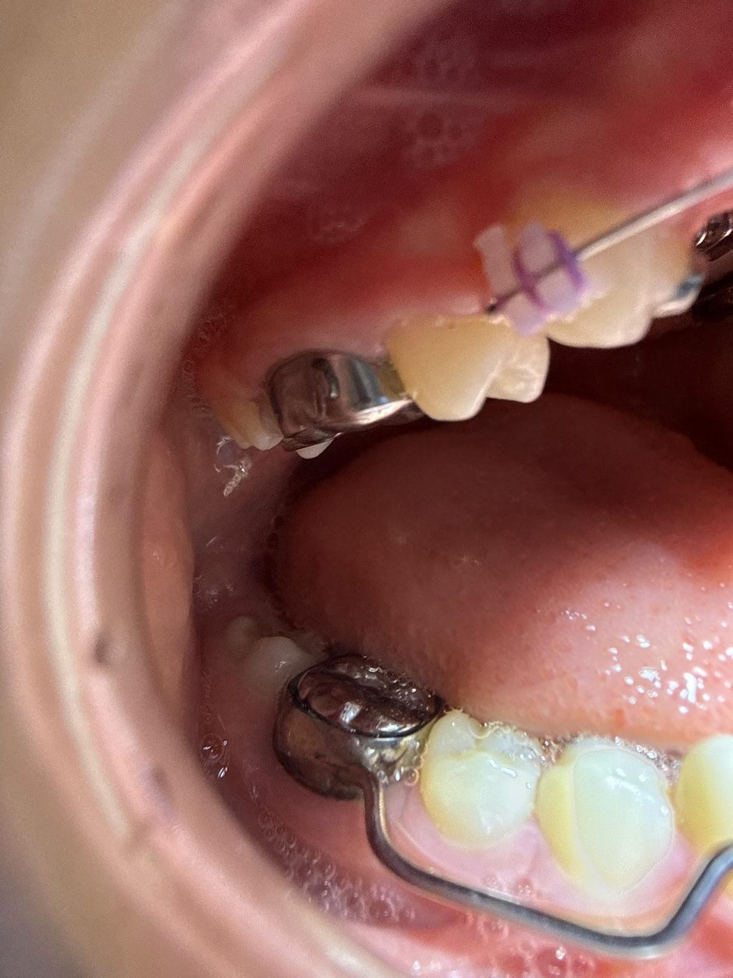 Close-up of a patient’s new braces, with a colored tie on one bracket