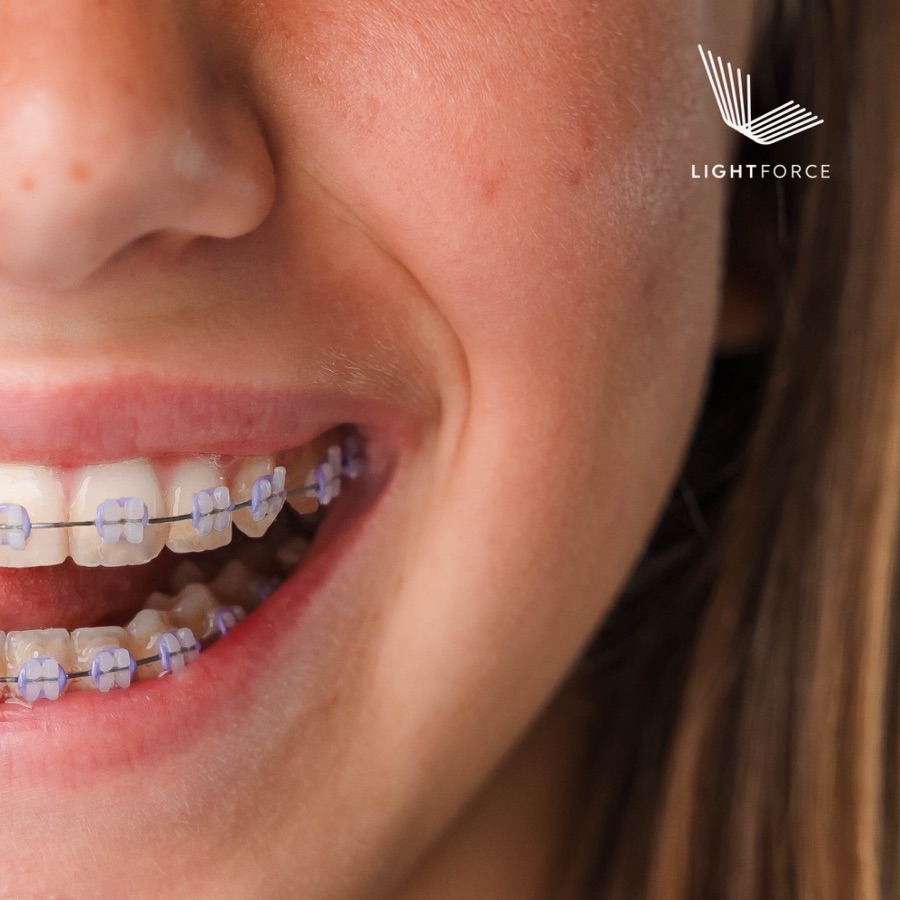 Close-up of a smile with LightForce braces and purple ties, with the LightForce logo