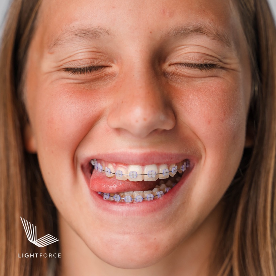 Teen girl laughing with LightForce braces and purple ties, with the LightForce logo