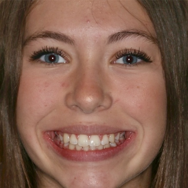 The same patient's smile after treatment