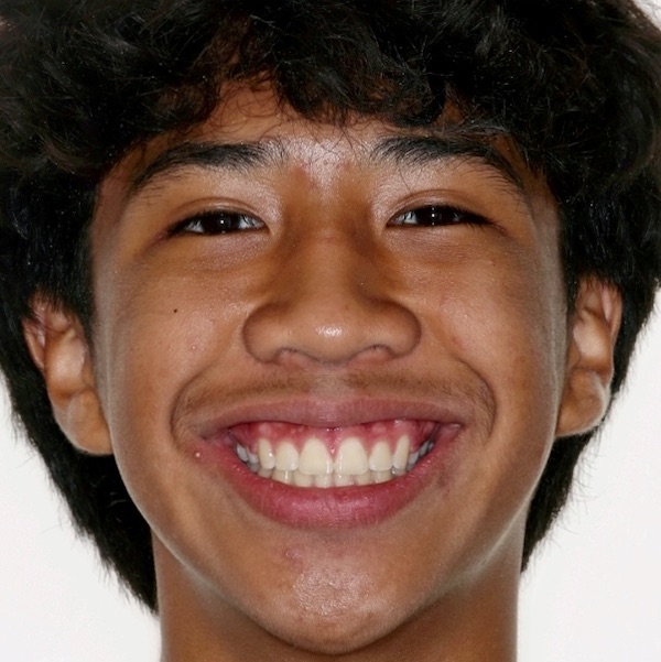 The same patient's smile after treatment