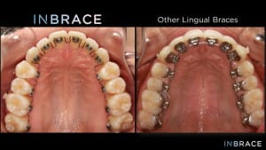 inbrace comparison, Miller Orthodontics