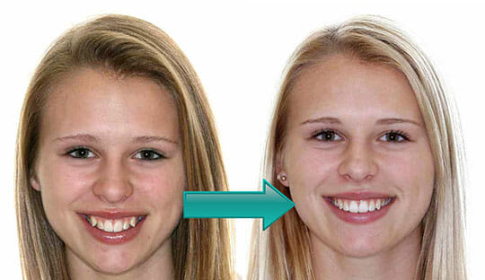 Miller Orthodontics - Alex before and after XBow treatment