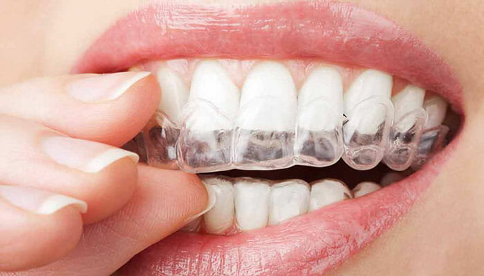 Miller Orthodontics clear braces / aligners, youth and kids orthodontics, invisalign-tray-teen-braces