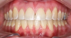 Peterson after anterior intraoral, Miller Orthodontics Blog