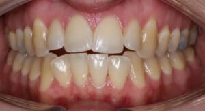 Peterson before anterior intraoral, Miller Orthodontics Blog