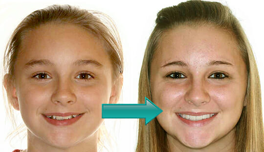 Miller Orthodontics - Darrah before and after extractions
